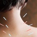 Acupuncture helps prevent vomiting in children?