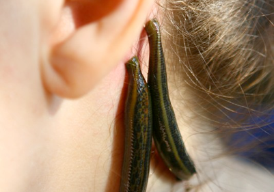 Leech therapy