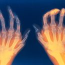 Can Periodontal bacteria cause rheumatoid arthritis ?