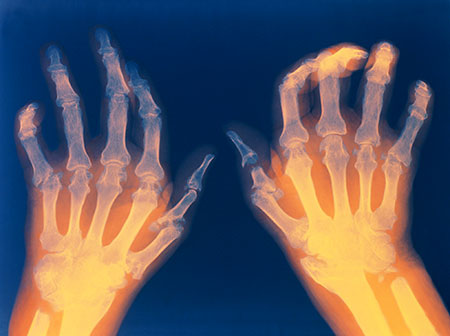 Rheumatoid arthritis 