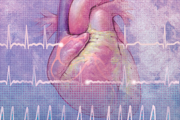 Atrial fibrillation