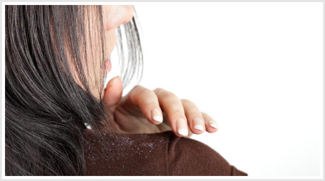 Dandruff